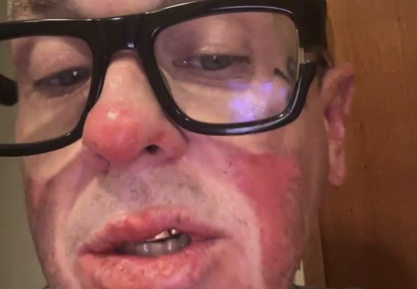 Sid Wilson of Slipknot Gives Update on Burn Injuries
